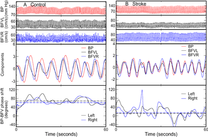 Spontaneous oscillations of blood pressure (BP) and cerebral blood flow velocity (BFV) in (A) a 72-year-old healthy woman and (B) a 62-year-old woman with left MCA stroke 