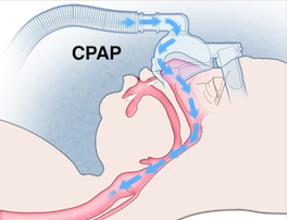 Effect of CPAP on the Airway