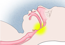 Figure 2: Obstructed Breathing