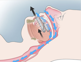 Effect of oral appliance on the airway