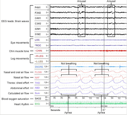 Polysomnogram