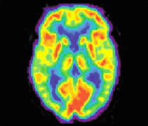 PET Scan of the brain